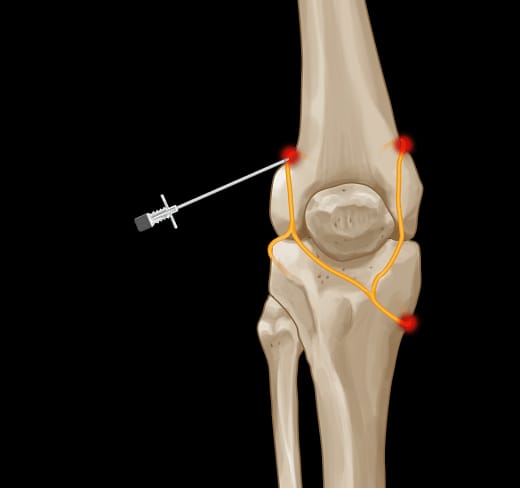 Knee Pain Procedures
