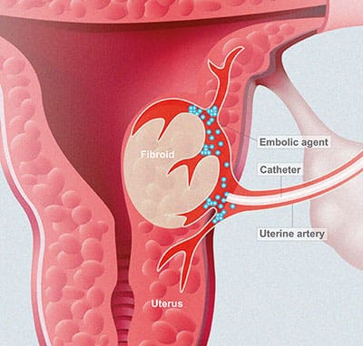 Uterine Fibroid Treatment