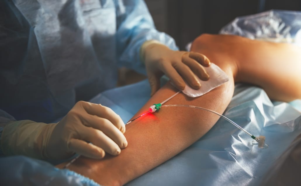 Varicose Vein Treatment